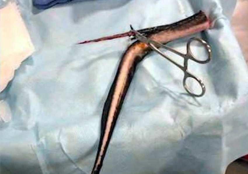 Otrovni rep raže koji je izvađen iz Kristi tokom intervencije