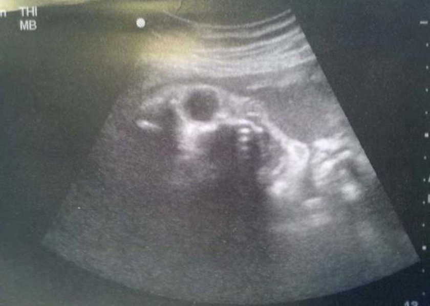 Demoniczne zdjęcia USG. Matki bały się porodu