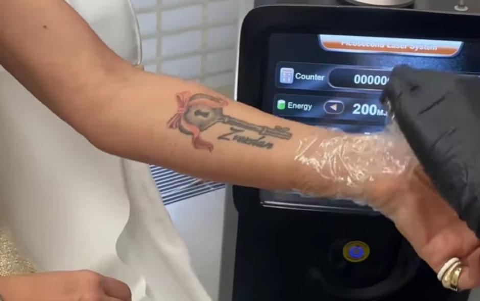 Ana Ćurčić uklonila tetovažu koju je posvetila Zvezdanu Slavniću