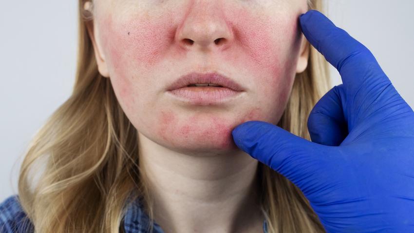 Rosaceás arcbőr kezelés kipirosodás