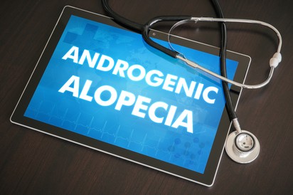 Kopaszodás, androgén alopécia oka, tünetei és kezelése