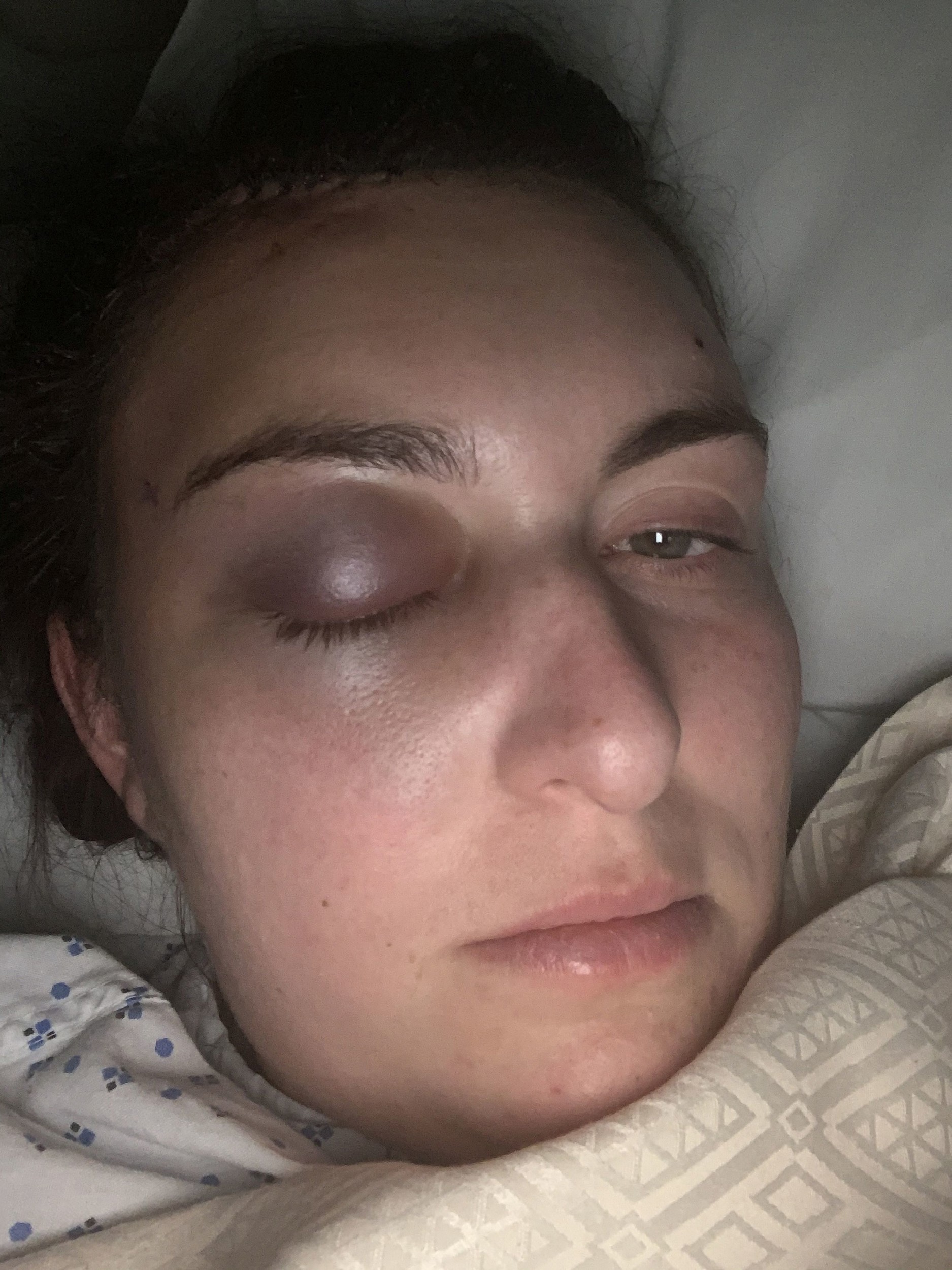Jenny mala veľmi napuchnuté pravé oko.