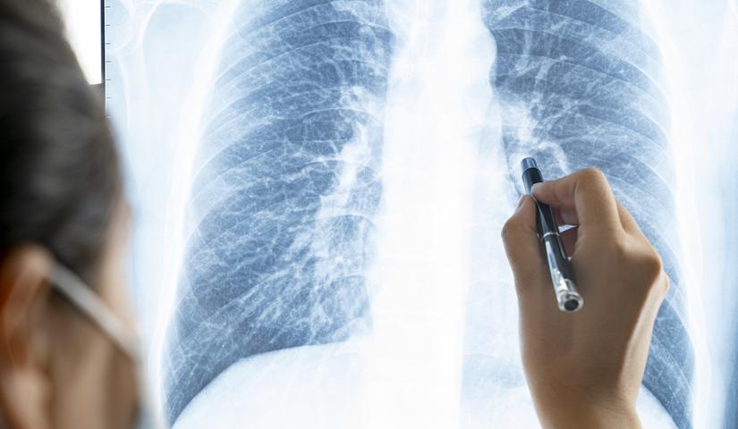 Tüdőrák: ezekkel a vizsgálatokkal deríthető fel a daganat