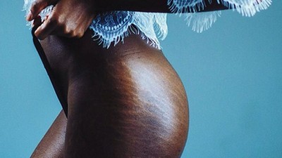 Here's how you can fade your stretch marks [Pinterest]