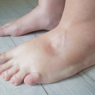 Ödémás láb: innen tudhatja, hogy szívprobléma okozza