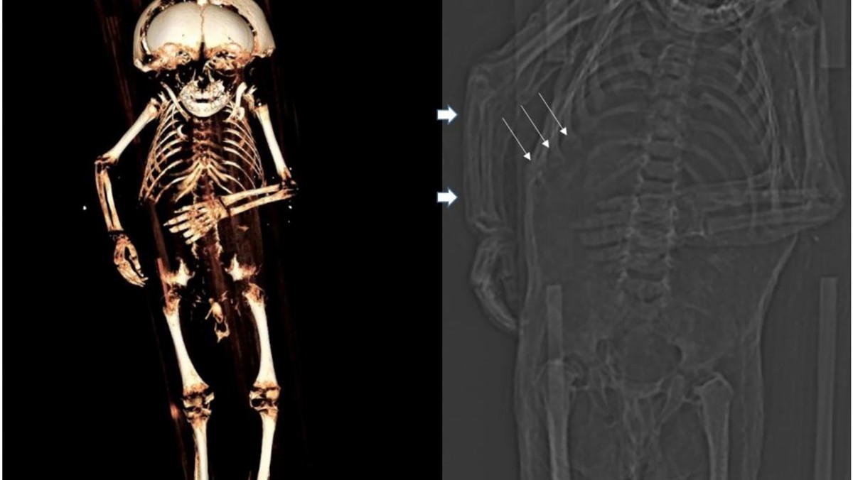 Na obrazie z tomografii widać różaniec krzywiczy: miejsca zrośnięcia żeber z mostkiem, będące objawem niedoborów witamin D i C