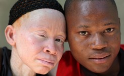 Rzeź albinosów w Malawi. 'Mordercy wierzą, że ich kości zawierają złoto'