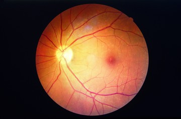 diabéteszes retinopátia, cukorbetegség, diabétesz, retina, látóideg, szemvizsgálat
