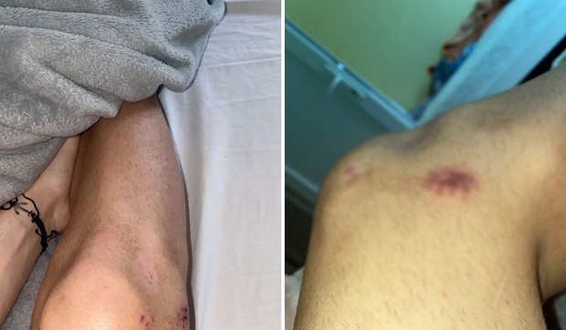 ujed psa bačka topola pas lutalica