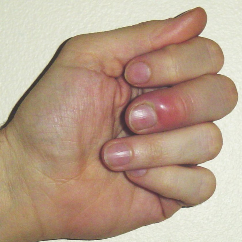 Obgryzanie paznokci