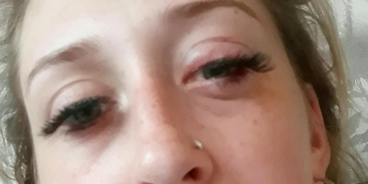22-latka omal nie straciła wzroku z powodu sztucznych rzęs