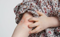 Atopowe zapalenie skóry to nie prosta wysypka. Czy pomaga dieta eliminacyjna?