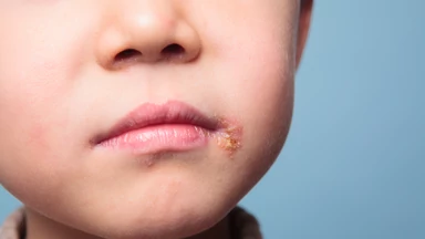 Wirus opryszczki u dzieci ─ objawy i leczenie
