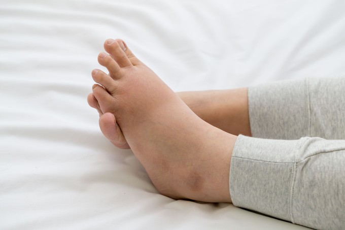 Ödémás, felpüffedt láb: ilyen, amikor vitaminhiány áll a háttérben