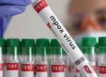 Tension rises as Mpox outbreak surges, remains uncontrolled in Africa