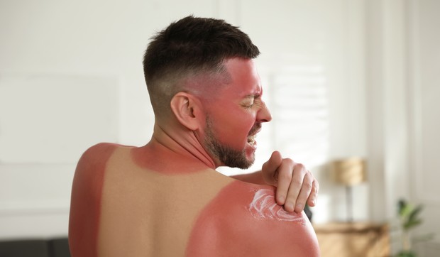 Trovanje suncem je težak oblik opekotina od sunca 