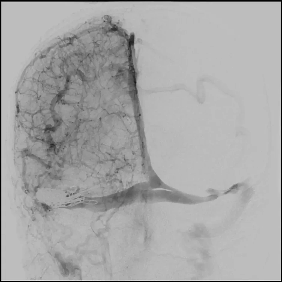 Stent je ugrađen mladom pacijentu koji je već sutradan otišao kući 