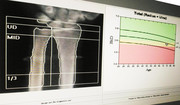  Pomiar gęstości kości - densytometria, przebieg pomiaru, wyniki 