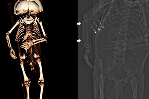 Na obrazie z tomografii widać różaniec krzywiczy: miejsca zrośnięcia żeber z mostkiem, będące objawem niedoborów witamin D i C