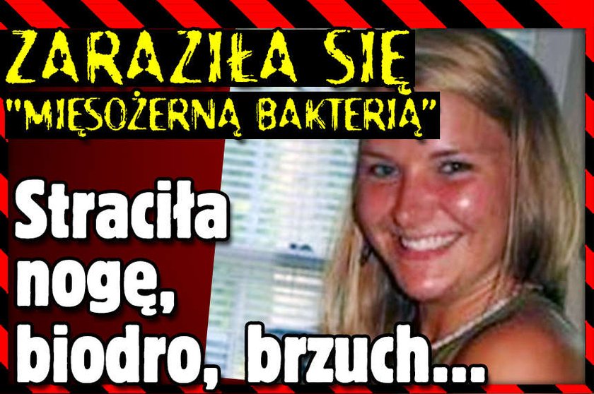 zarazila sie miesozerna bakteria