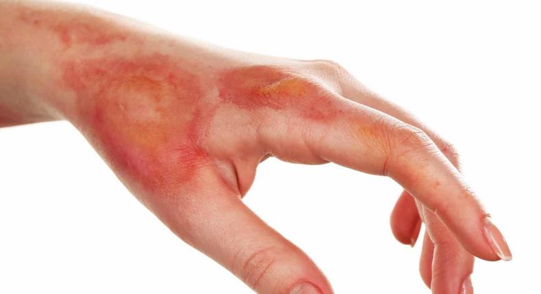 Here is how to heal burns in fast and safe ways