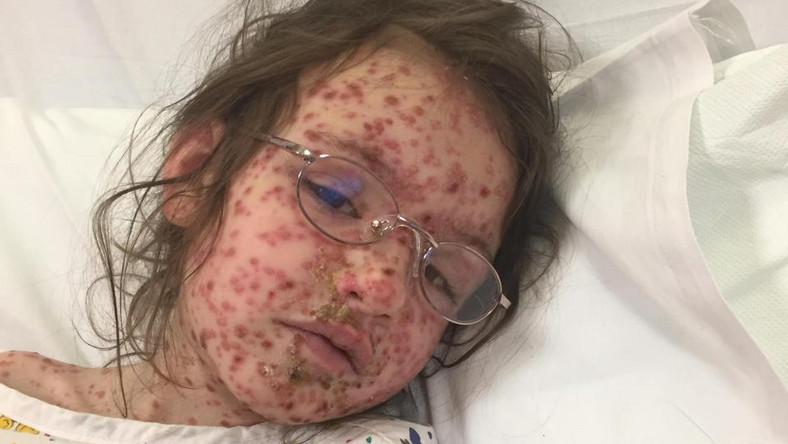 "The Sun" opisuje historię 5-letniej Evie Beth, która zachorowała na ospę wietrzną. Powszechna dziecięca choroba przyniosła jej wyjątkowe cierpienie. Mówi się, że to najgorszy jej przypadek.