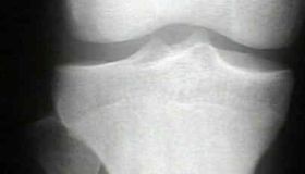 ost-osteoma-d00000ABD9ebef105cf5f