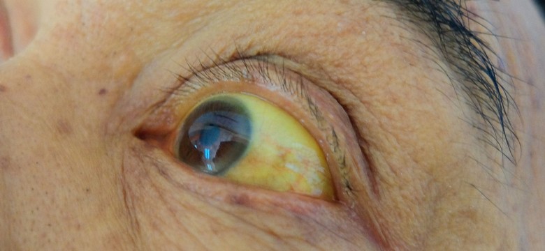 Szczepionek na żółtaczkę jak na lekarstwo. Liczba chorych rośnie zaś lawinowo