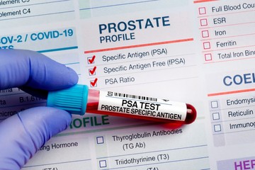 proszataszűrés prosztatarák rákszűrés PSA eredménye