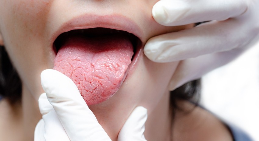 The tongue ages over time, so it's common for older adults to develop deep fissures on the previously soft tongue, which can be a breeding ground for bacteria, so it's worth paying more attention to oral hygiene than usual.