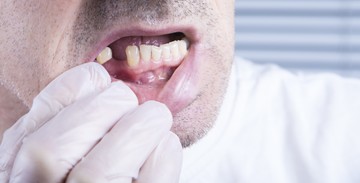Átlagosan ennyi foga hiányzik a magyaroknak felnőtt korukra