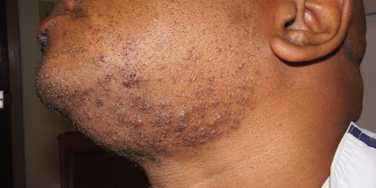 5 Fast Ways To Treat Razor Bumps At Home Pulse Nigeria 