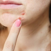 Hormonzavar is okozhatja, ha így néz ki az arcbőre