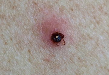 A kullancs kedveli a testhajlakokat (pl. hónalj, ágyék), gyakran bújik a fülek mögé, sőt, a hajban is menedékre talál. Amikor a kullancs a szájszervével sebet ejt a bőrön, érzéstelenítő váladékot juttat a nyílásba, ezért csak ritkán vesszük észre azonnal a támadót.