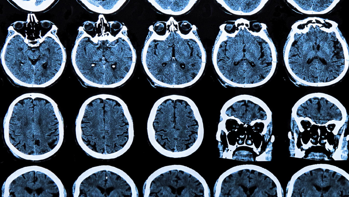 Grupa naukowców z Chicago przeprowadziła specjalne testy, dzięki którym udowodniła, jak wykryć symptomy choroby Alzheimera już 18 lat wcześniej.