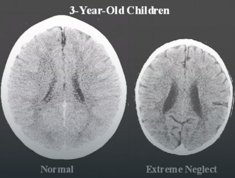 Mozgovi dva trogodišnjaka: Normalno (levo) i dete koje je zanemarivano (desno)