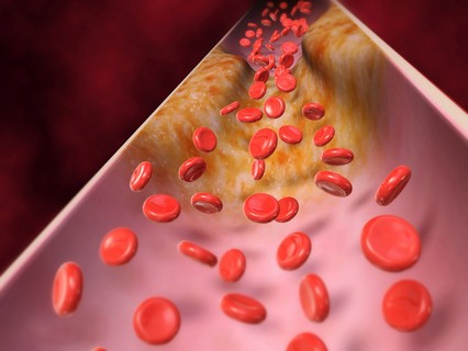 Familiáris hiperkoleszterinémia - Életet menthet a korai felismerés