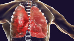 Inhalacje z soli fizjologicznej - co to, kiedy wykonywać, a kiedy są niewskazane?