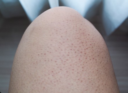 Grízes bőr: a keratosis pilaris oka, tünetei és kezelése