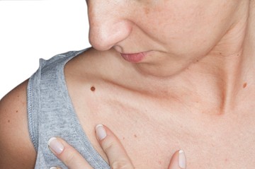 Melanóma Világnap: az ABCDE szabályon kívül fontos a rút kiskacsa jel is