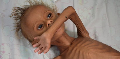 To dziecko umiera z głodu. W jego kraju cierpią miliony