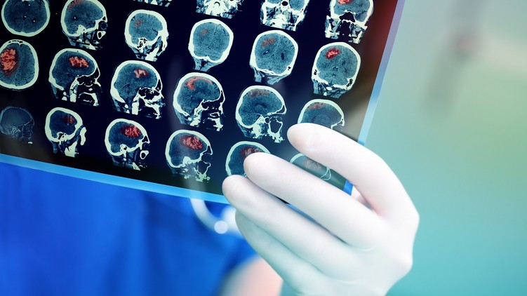 stroke sztrók után gyógyulás rehabilitáció módszerek