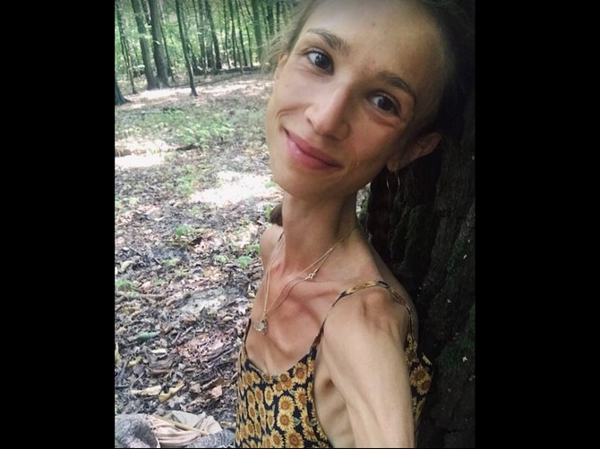 Karolina je umrla od iscrpljenosti i gladovanja