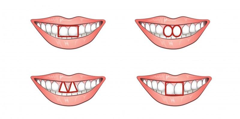 A tiéd milyen? Ezt árulja el metszőfogad formája a személyiségedről