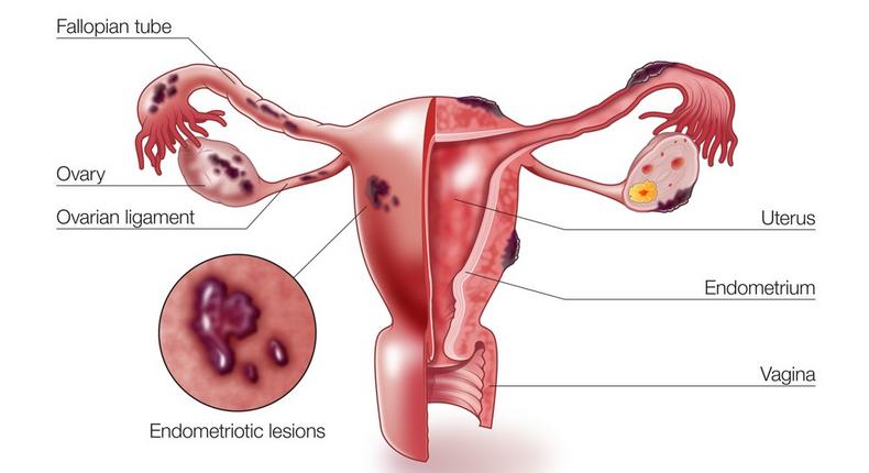 A diagram showing how endometriosis occurs in female reproductive organs