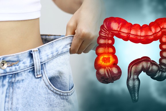 Koliki gubitak kilograma može da bude znak raka debelog creva