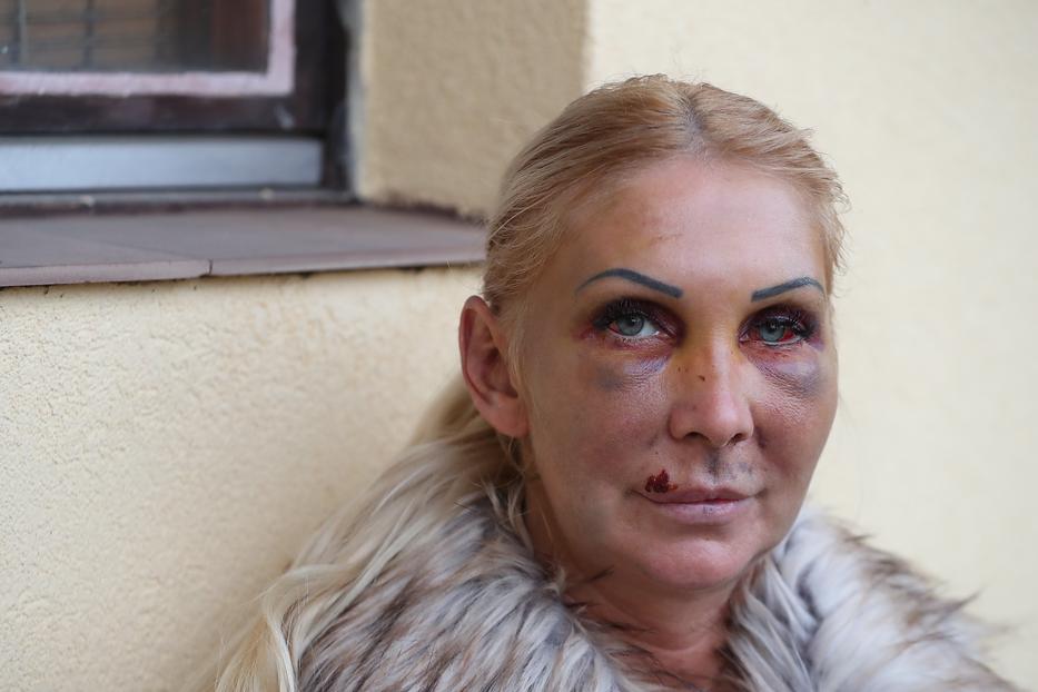 Orosz Bernadettet volt párja bántalmazta súlyosan /Fotó: Pozsonyi Zita