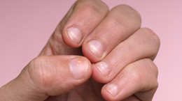 Czy zmiany na paznokciach mogą świadczyć o chorobach wewnętrznych?