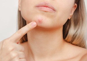 Mesto akni na licu pomaže u određivanju načina lečenja