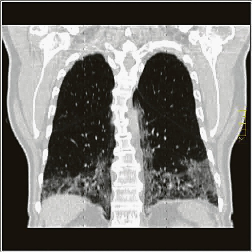 Progresivna faza (5. do 8. dan) - povećanje broja GGO i crazy paving